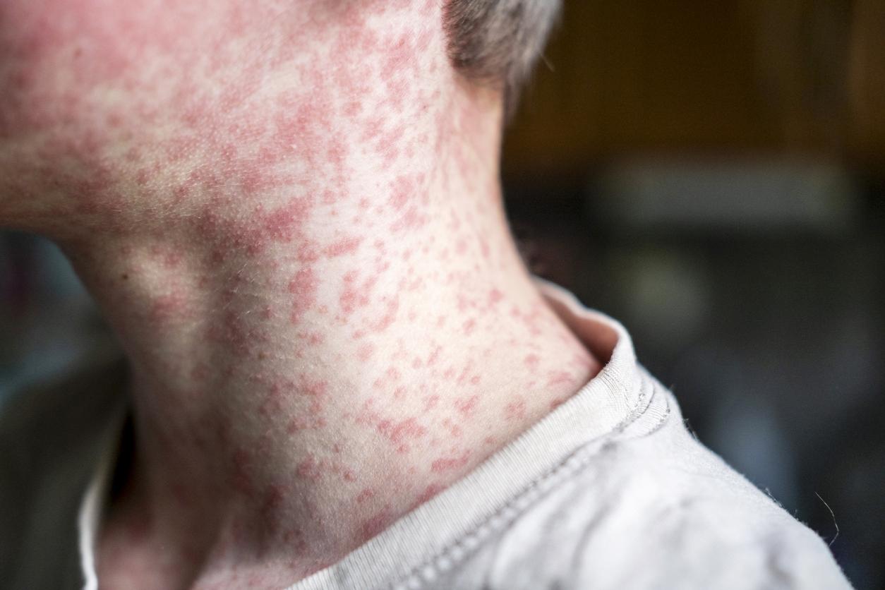 Close up of boy with measles rash.